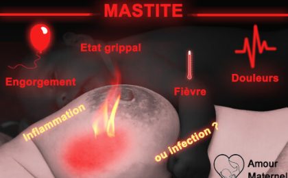 mastite allaitement