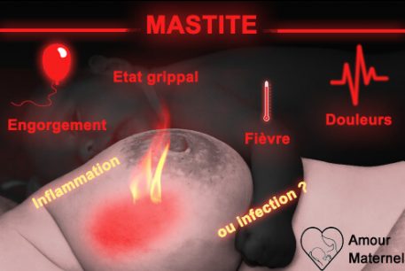 mastite allaitement