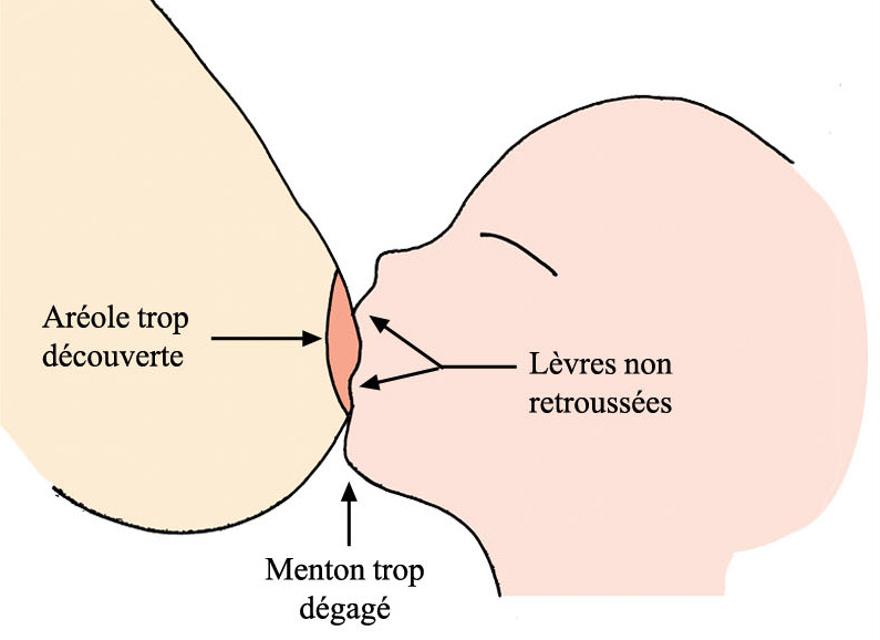 mauvaise prise du sein