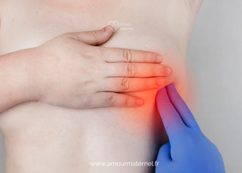 allaitement douleur irradiante